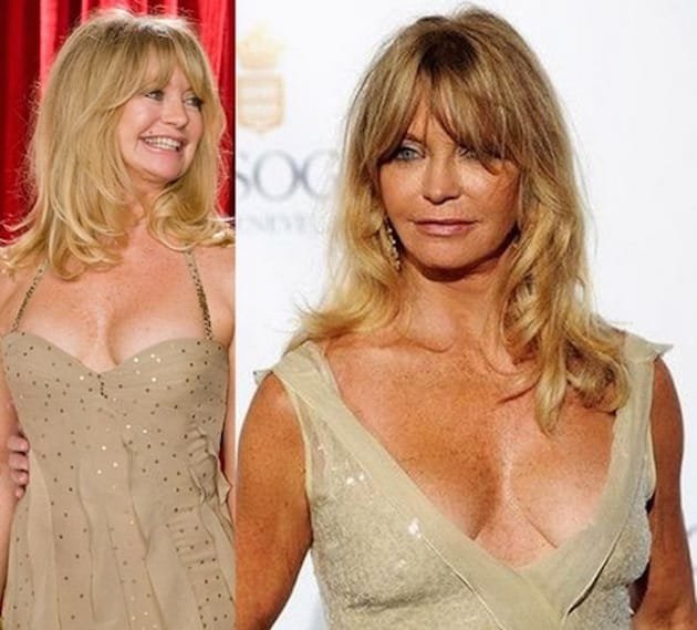 Goldie-Hawn-Breast-Augmentation-surgery-2