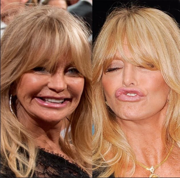 Goldie-Hawn-Fishy-Lips-Lip-Injection