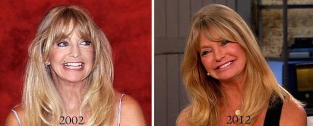 Goldie-Hawn-plastic-surgery-1-1