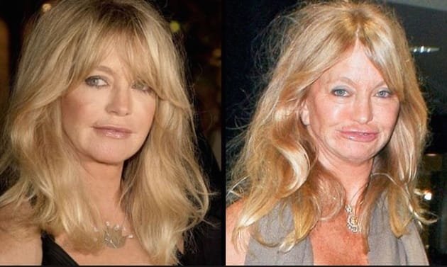 Goldie-Hawn-plastic-surgery