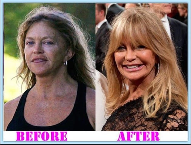 Goldie-Hawn-plastic-surgery-2