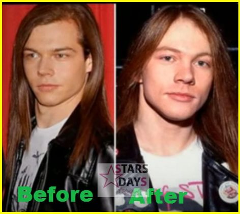 Axl Rose Plastic Surgery Bad - Celebrity News, Gossips, Rumors and ...